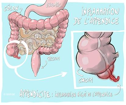 http://snfge.01.dev.cyim.com/sites/snfge.01.dev.cyim.com/files/styles/media_library/public/medias/images/appendicite_aigue_illustration_olivier_juanati_-_c_snfge_bd.jpg