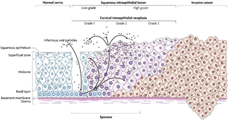 6.1.3.2. Cas particulier des lésions intra-épithéliales​